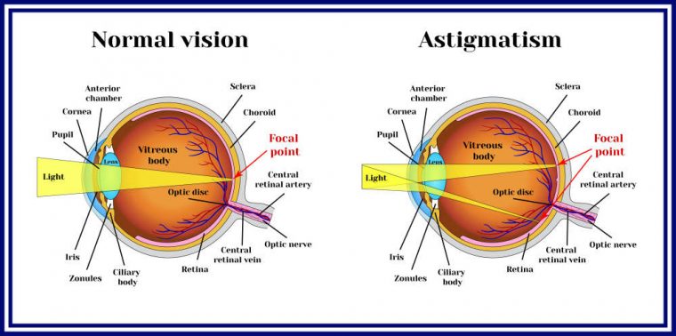 Photo Comparison Of Astigmatism At Night Mystical Raven Photo Comparison Of Astigmatism At Night Mystical Raven