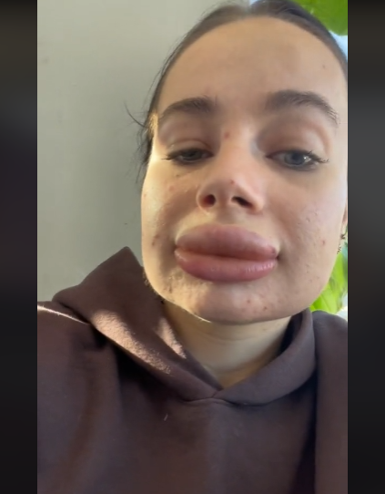 Jessica Burko had botched lip filler