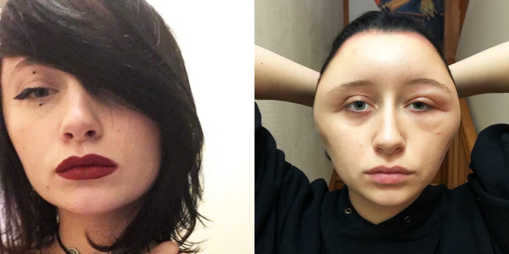  Woman’s Head Nearly Doubles In Size After Allergic Reaction To Hair Dye - Featured image