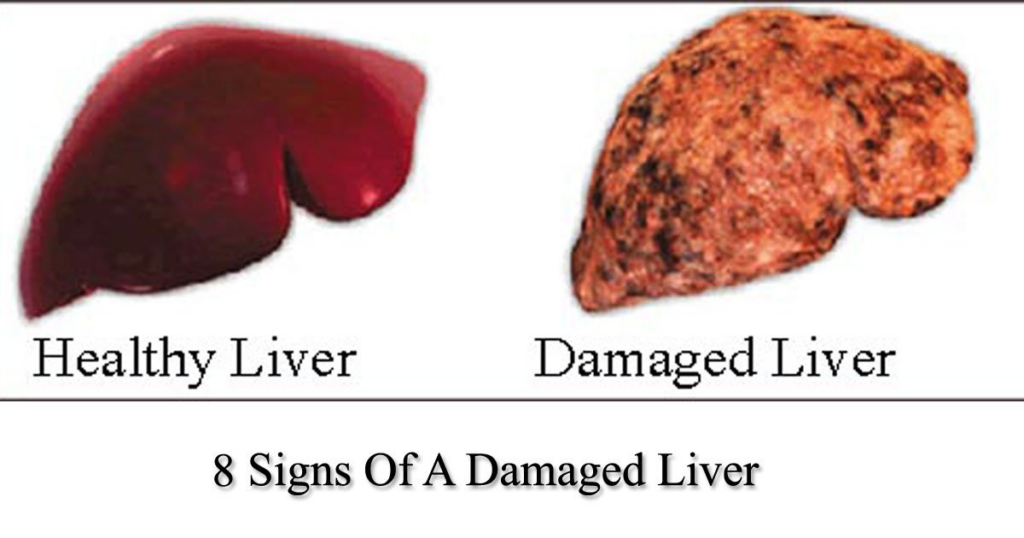 8 Alarming Signs And Symptoms Of Liver Disease That Shouldn’t Be Ignored - Featured image