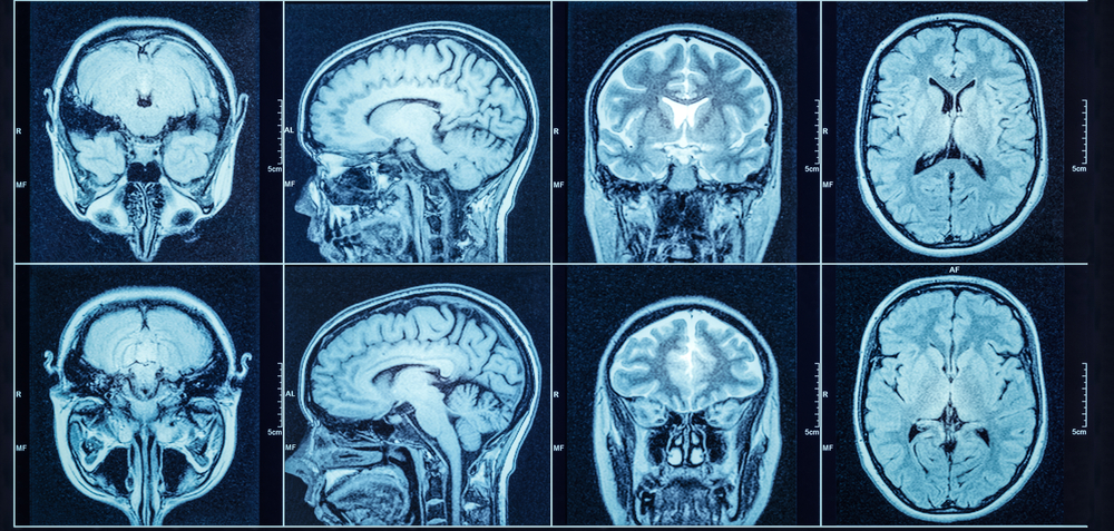 brain scan
